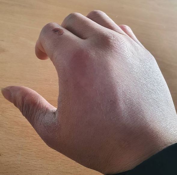 Jihoon Lee Bruised Arm Instagram